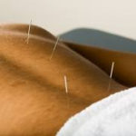 Acupuncture Pain